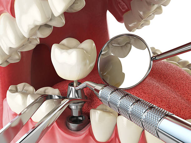 Best Emergency Root Canal Therapy in USA